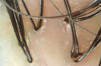 Image of scalp (100x magnification)